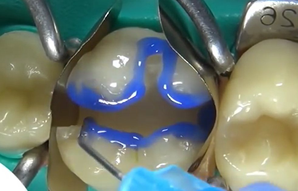 Минимальная реставрация зуба Сочи