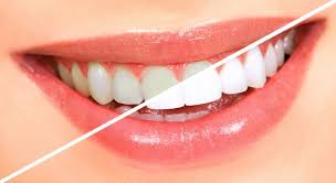 Профессиональное отбеливание зубов в Сочи цена и качество Вас приятно удивят