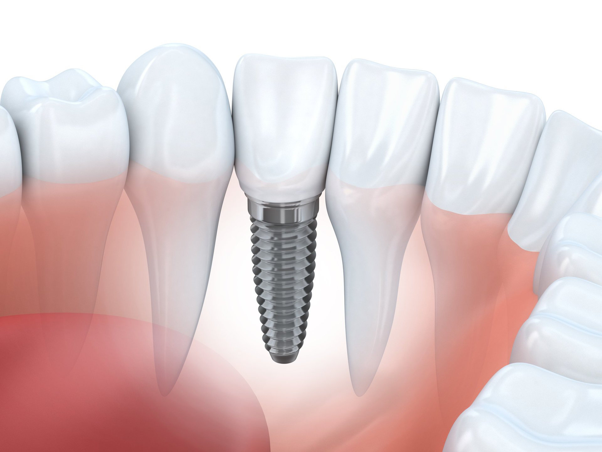 Имплантация зубов в Сочи - Профессиональный подход к имплантации Ваших зубов