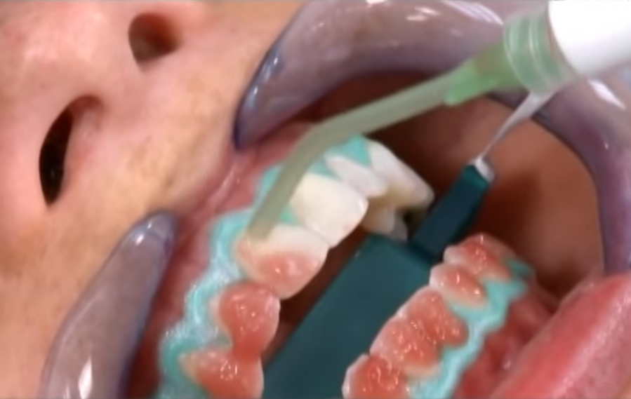 Акция отбеливание зубов Опалесценс Буст в клинике Сочи