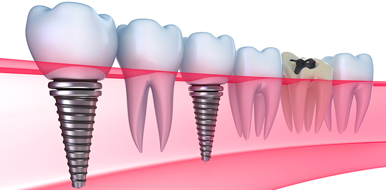 Современная имплантация зубов клинике Сочи цена лучшая в регионе