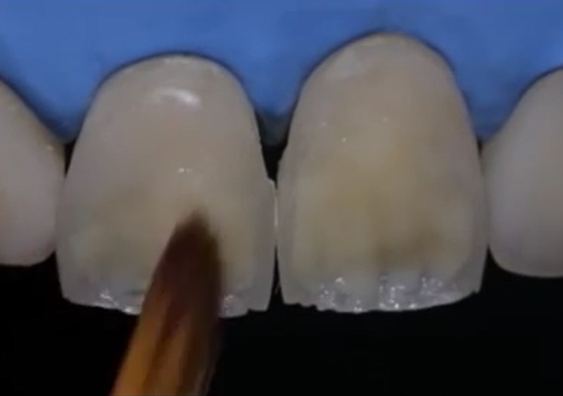 Композитная реставрация зубов в Сочи цена