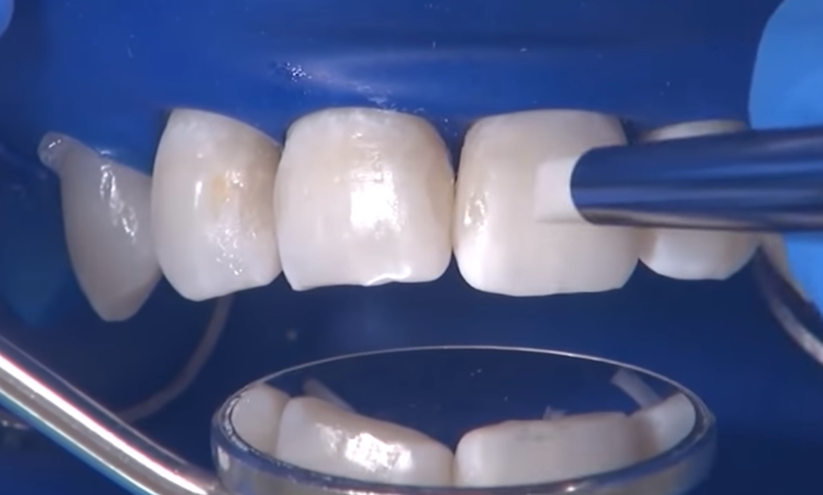 Косметическая реставрация зубов Сочи