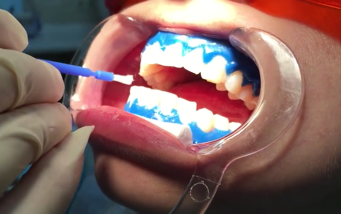 Отбеливание зубов стоимость в клинике