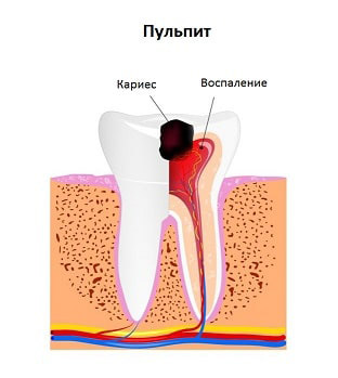 Лечение пульпит зуба, причины и симптомы заболевания