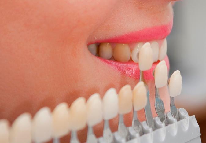 Виниры на зубы в стоматологической клинике Сочи цена и великолепный результат Вас порадуют