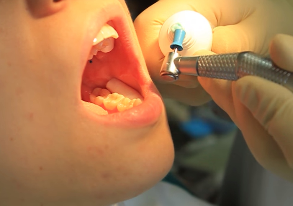 Временная пломба зуба ребенку