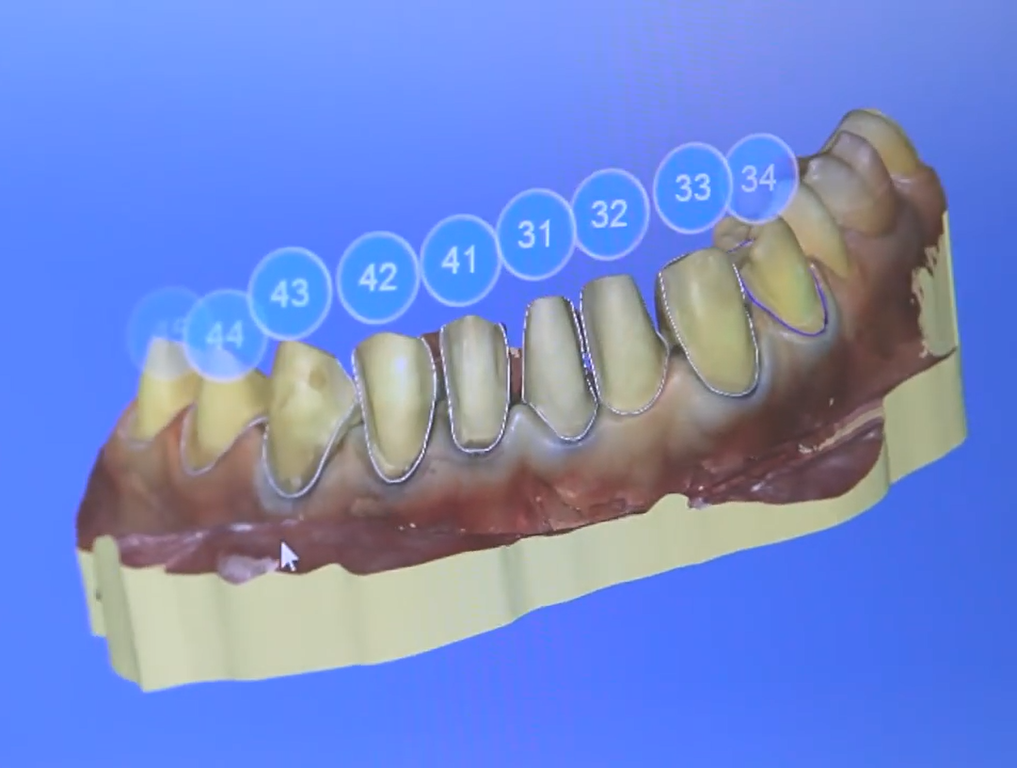 Художественная реставрация зубов по технологии CEREC 3D 